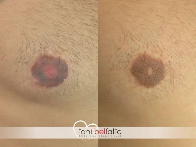 Ricostruzione dell'areola con dermopigmentazione, prima e dopo