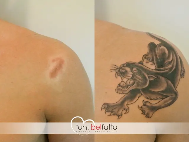 Cicatrice coperta con un tatuaggio artistico, prima e dopo