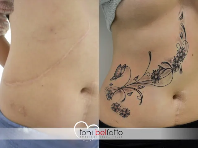 Cicatrice coperta con un tatuaggio artistico, prima e dopo