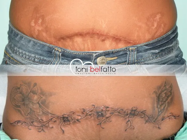 Cicatrice coperta con un tatuaggio artistico, prima e dopo