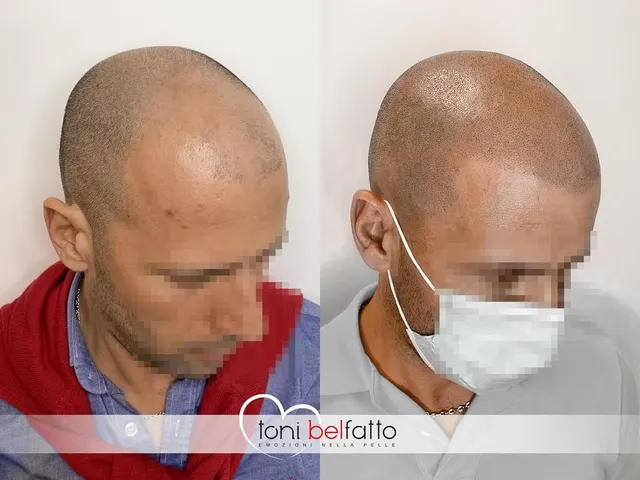 Tricopigmentazione, confronto prima e dopo