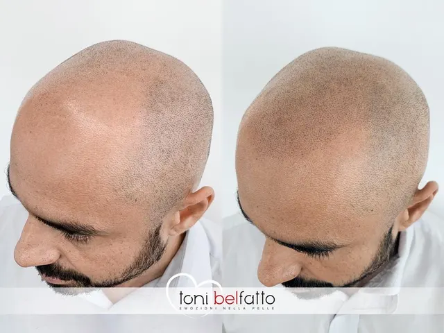 Tricopigmentazione, confronto prima e dopo