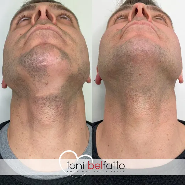 Tricopigmentazione della barba, prima e dopo