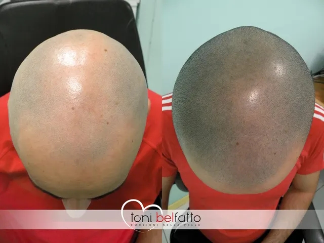 Tricopigmentazione, confronto prima e dopo