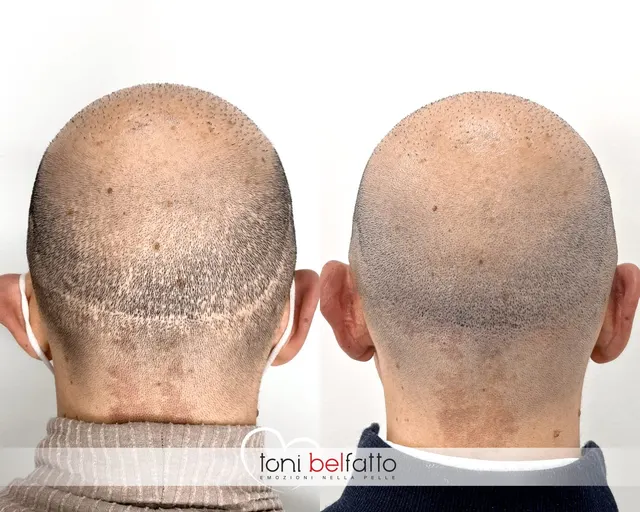 Tricopigmentazione su cicatrici da trapianto FUT e FUE, prima e dopo