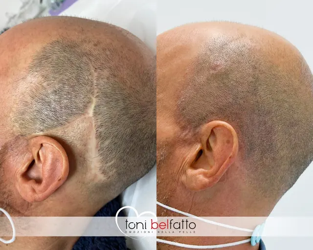 Tricopigmentazione, confronto prima e dopo