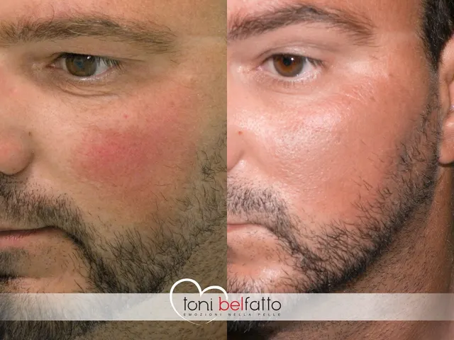 Vitiligine trattata con dermopigmentazione, prima e dopo